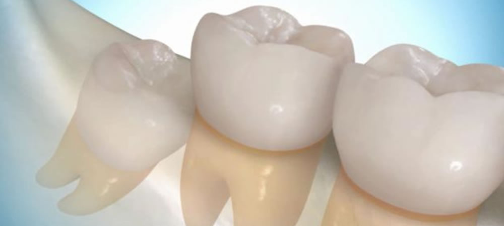 抜歯の特徴